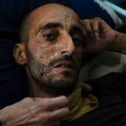 Man vårdas på Shifasjukhuset i Gaza stad i augusti. Arkivbild.