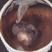 Illustrationsbild, en äldre kvinna gör en ögonundersökning/en tumör i ett öga.