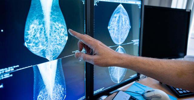 En läkare tittar på bröströntgenbilder. Christine Olsson/TT