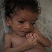 Den sju månader gamla bebisen Salem Awad lider av allvarlig undernäring. Bild från Gaza stad den 28 juli. 