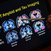 Arkivbild från 2015 där en neurolog visar resultat från en hjärnundersökning i en alzheimerstudie.