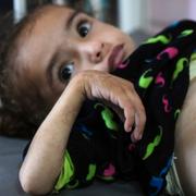 Mayar Al-Arja, 2, vårdas på Nassersjukhuset i södra Gaza. 