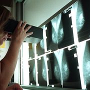 Överläkare Gunilla Svane på radiumhemmets mammografienhet, vid Karolinska sjukhuset i Stockholm, undersöker röntgenplåtar. Arkivbild.