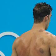 Michael Phelps hade blåmärken på ryggen efter koppning i OS-finalen.