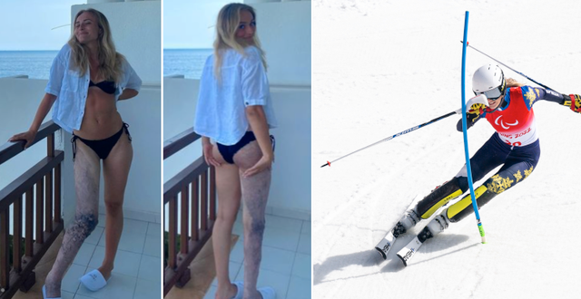 Ebba Årsjö visar upp sitt ben. Instagram/TT