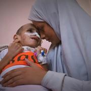 Nour al-Hams håller sitt syskonbarn, treåriga Amr al-Hams, i familjens tält på Nasser-sjukhuset i Khan Yunis. 25 juni 2025. 