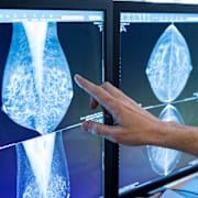 En läkare tittar på mammografibilder.