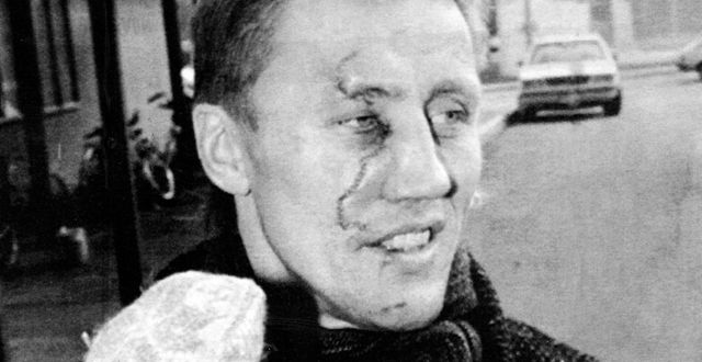 Börje Salming utanför sjukhuset i Toronto, Kanada, efter att han fått en skridsko i ansiktet och sytt 300 stygn den 27 november 1986.  Toronto Sun/AP/TT
