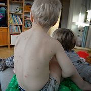 Barn med vattkoppor.