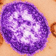 Arkivbild: Mässling orsakas av ett extremt smittsamt virus.