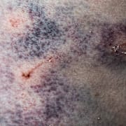 Kvinna med blåmärke på låret. Illustrationsbild. 