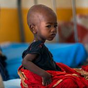 Ett undernärt barn på en klinik i Dollow, Somalia.