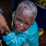 Ett barn med mpox får behandling i Munigi i östra Kongo-Kinshasa på fredagen. 