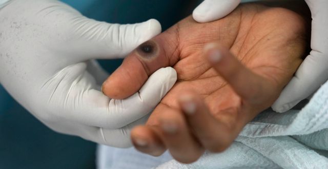 En läkare visar en patient med apkoppors hand. Martin Mejia / AP